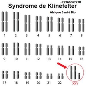 SYNDROME DE KLINEFELTER