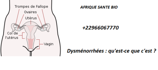 Dysménorrhées : qu'est-ce que c'est ?