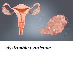 Qu'est-ce que la dystrophie ovarienne ?