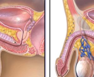 Ovule contre Varicocèle varices aux testicules