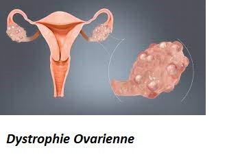 Problème dystrophie ovarienne