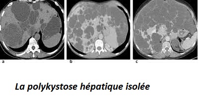 La polykystose hépatique isolée