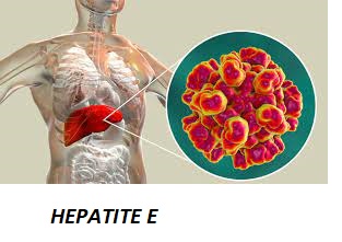 Qu'est ce que l'hépatite E ?