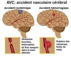 Attaque cérébrale (AVC) Définition et Causes