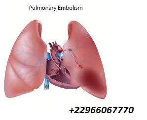 Une embolie pulmonaire