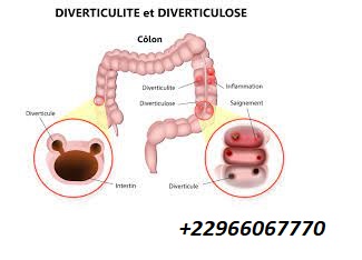 Diverticulose du colon traitement