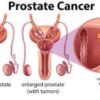 Cancer de la Prostate Remède Naturel Cancer de la Prostate