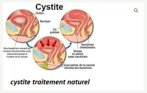 Cystite Traitement Naturel Infection de la Vessie