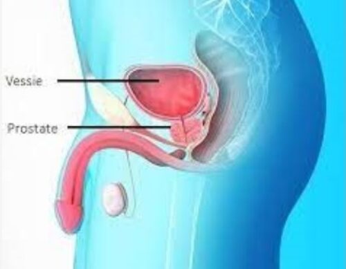 Prostatite Traitement Naturel Hypertrophie de la Prostate
