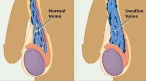 Voici le Meilleur Traitement de la Varicocèle Testiculaire